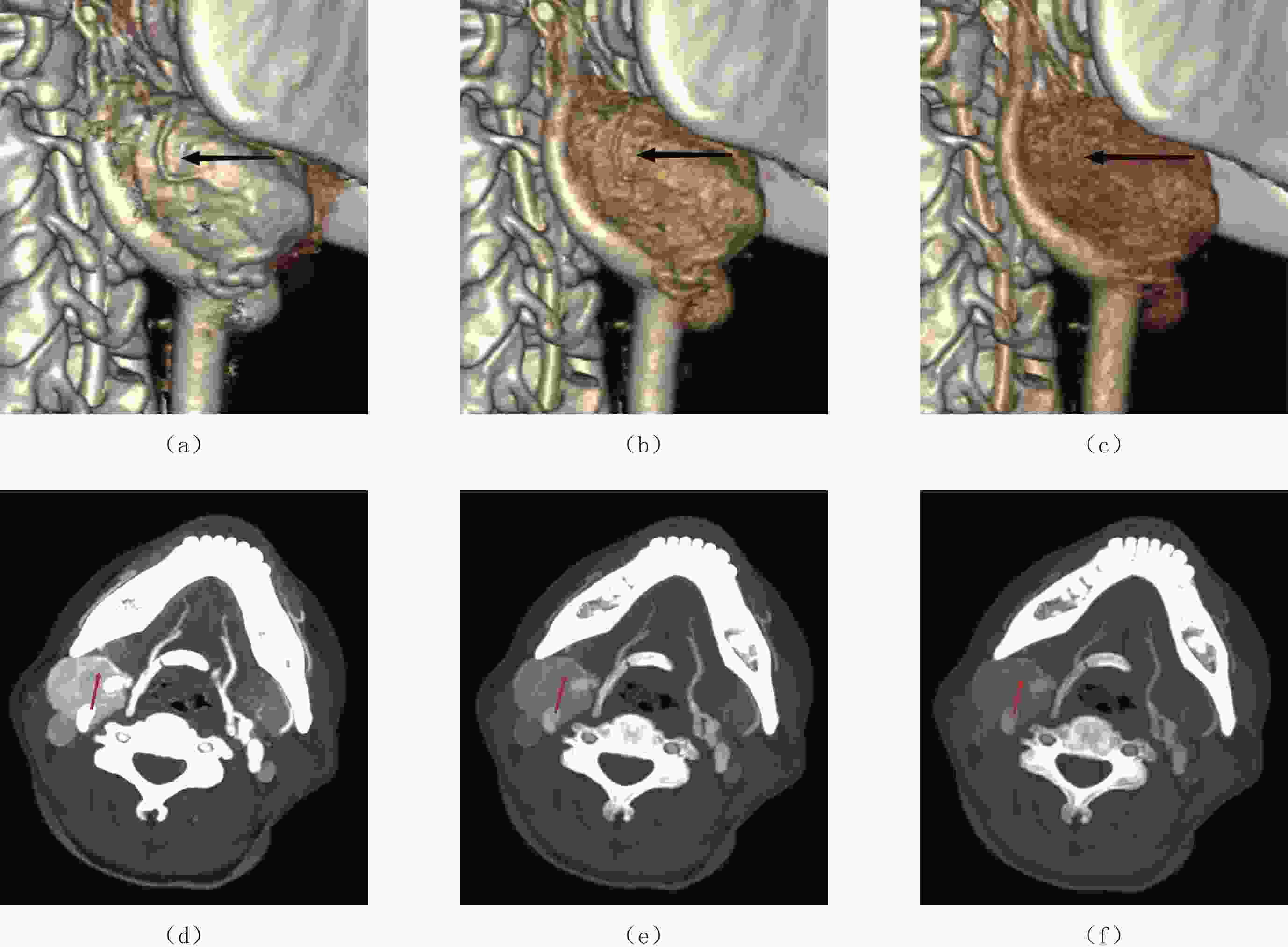 壹生资讯-颈内动脉影像解剖：3D模式展示